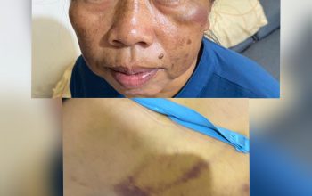 Aniaya ART, Oknum Dokter PNS di Bandarlampung Dilaporkan ke Polisi
