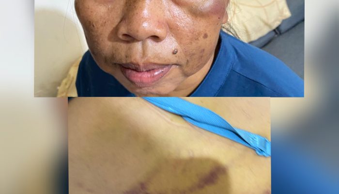 Aniaya ART, Oknum Dokter PNS di Bandarlampung Dilaporkan ke Polisi